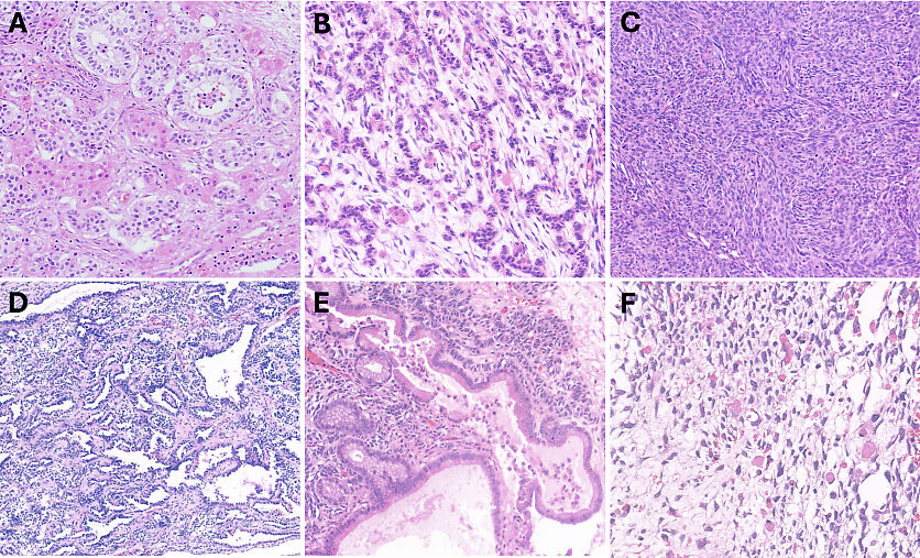 Pathology of Ovarian, Fallopian Tube and Primary Peritoneal